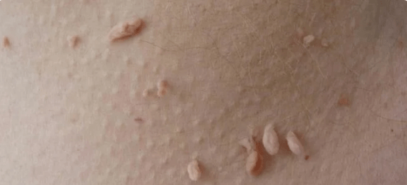 HPV transmission method