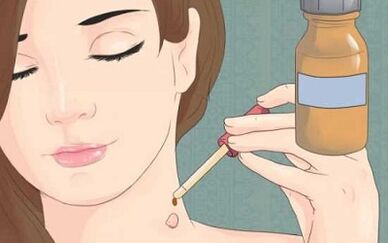 How to get rid of popular papillomas remedies