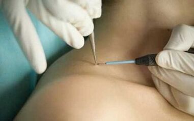 Papilloma removal methods