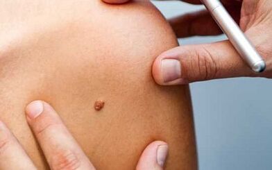 Papillomas treatment methods