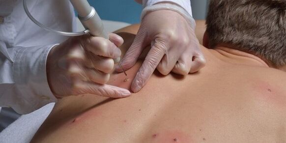 Papillomas removing