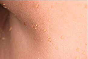 How are the papillomas in the body