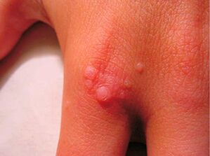 How to get rid of small papilomas