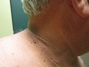 The reasons for the appearance of plural papillomas in the body