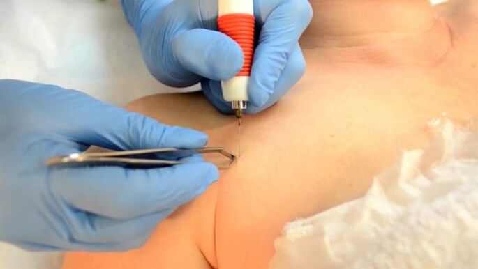 Electrocoagulation - a method for removing papillomas