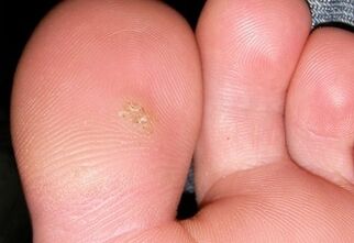 how to get rid of plantar wart