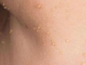 reasons for the appearance of papillomas on the body