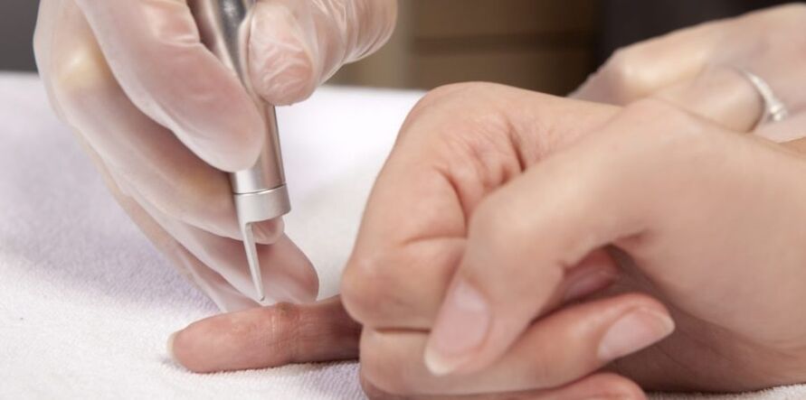 ways to remove papillomas on hands and why they are dangerous