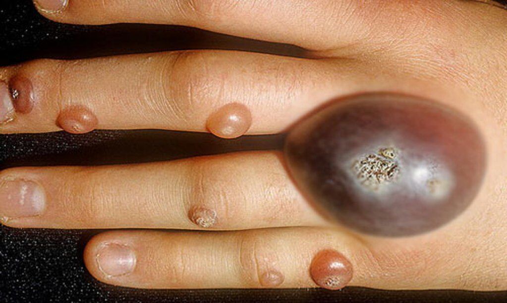 large warts on hand