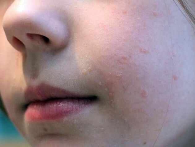 Flat warts on the face appear more frequently during adolescence
