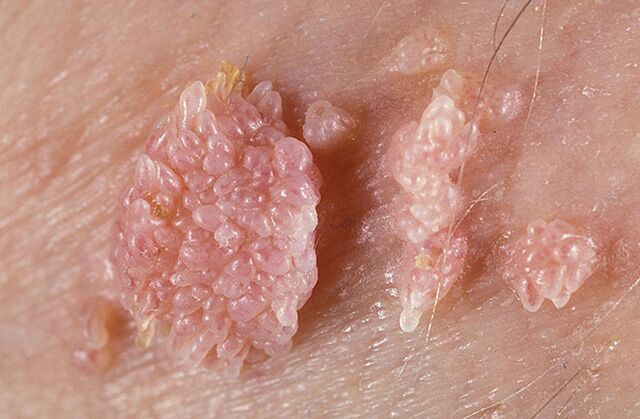 Papilloma is a benign tumor-like formation of the skin and mucous membranes of a warty nature